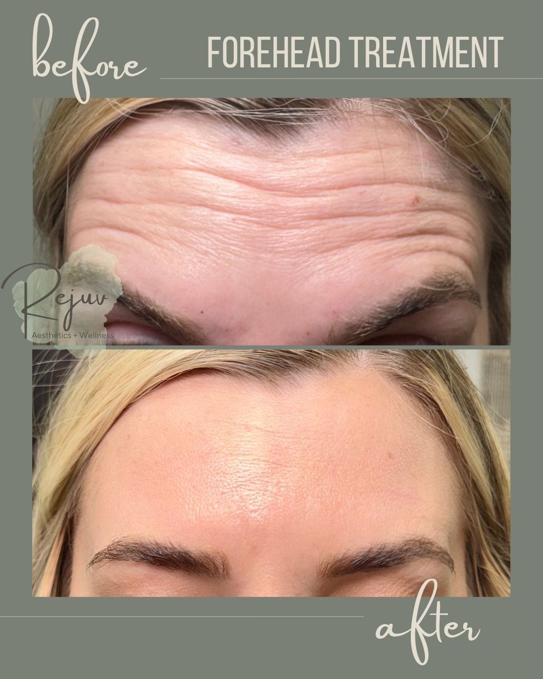 Before-and-after forehead treatment showing reduced wrinkles and smoother skin after.