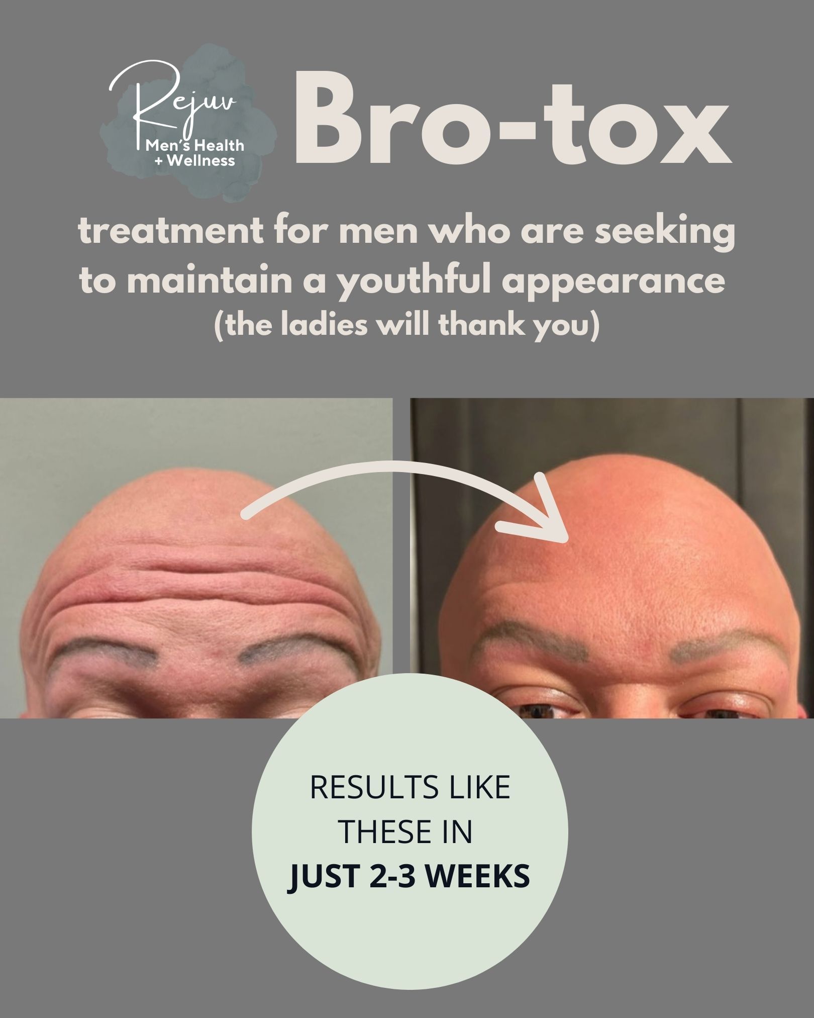 Promotional graphic for Bro-tox with before-and-after forehead images and text claiming results in 2-3 weeks