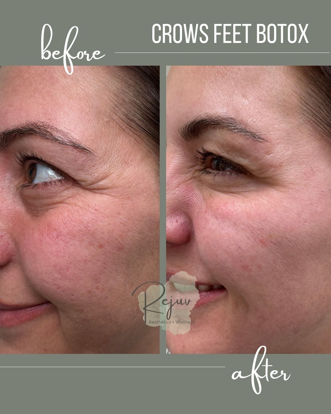 Side-by-side close-up profile of a woman before and after Botox, showing fewer crow’s feet on the after side.