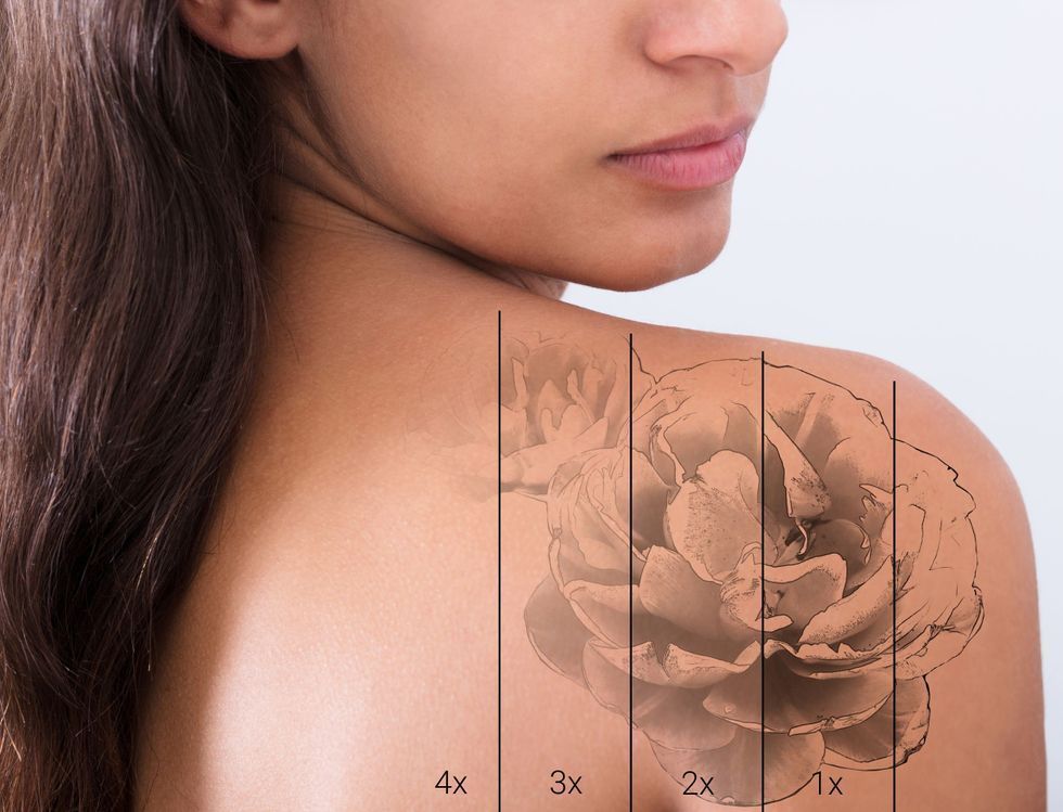 permanent tattoo verwijderen