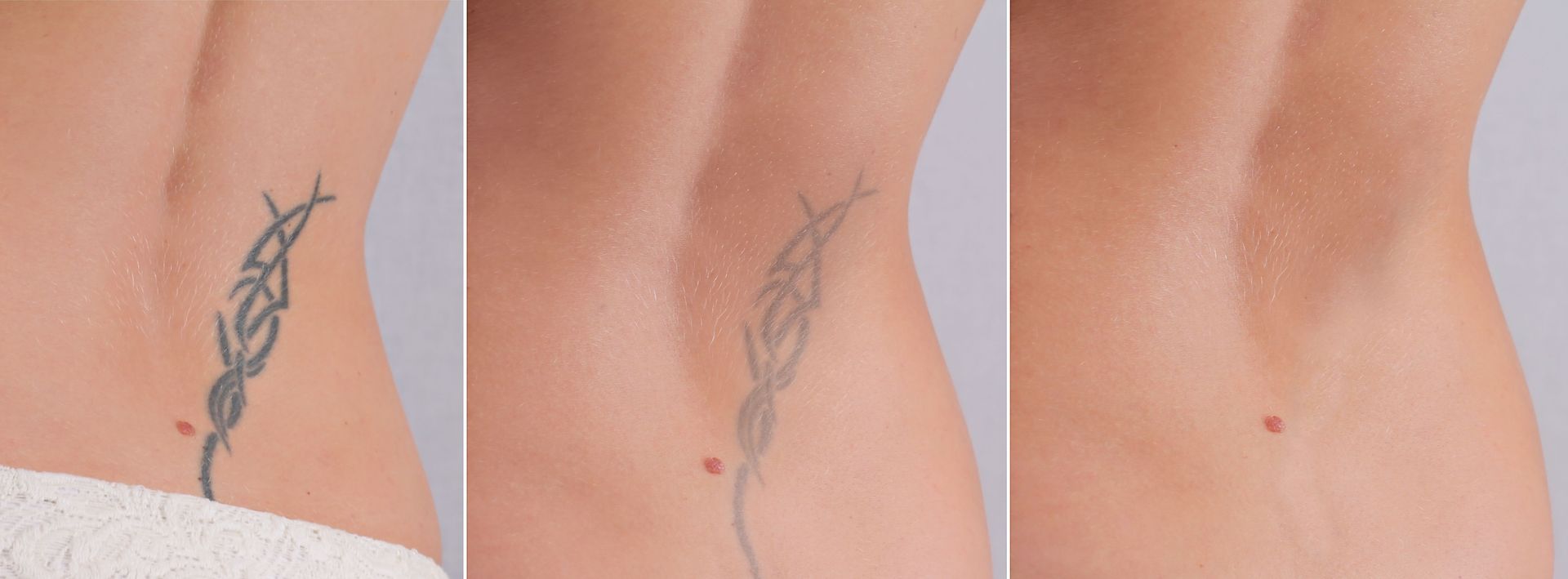 tattoo weglaseren