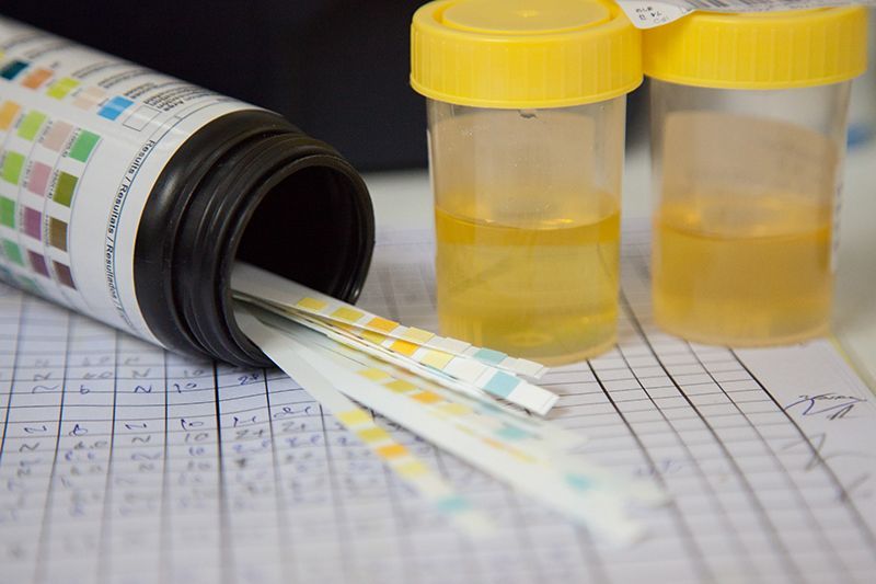 Urine Strip Test And Sample Urine Strip Test And Sample