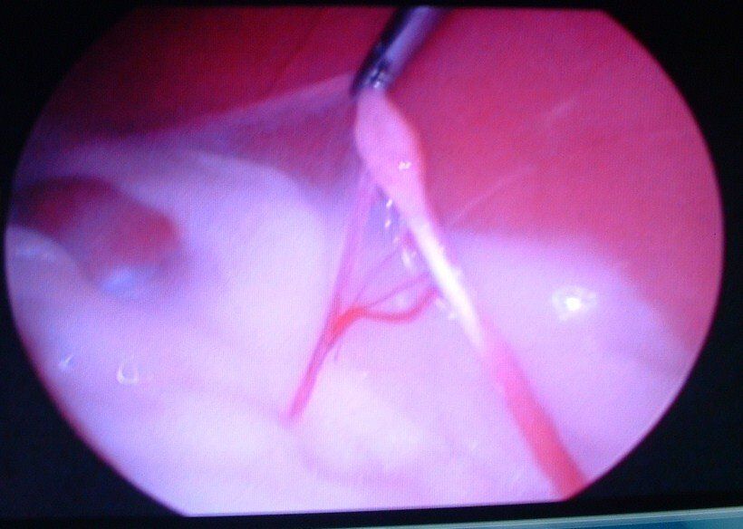 laparoscopia