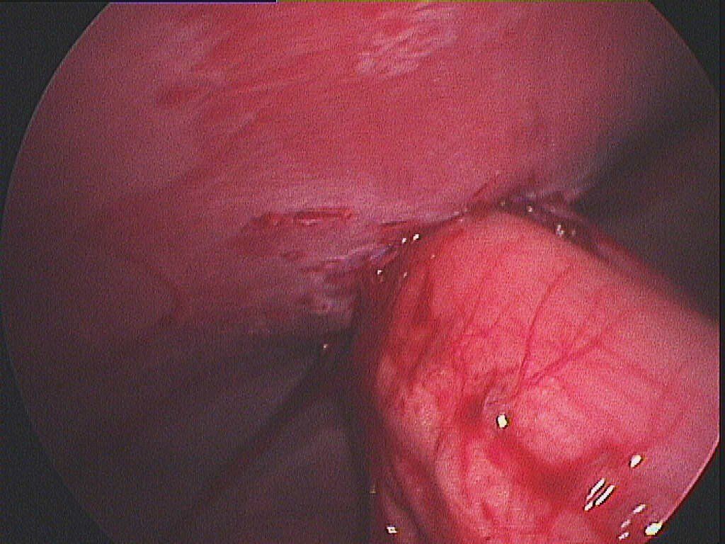 laparoscopia
