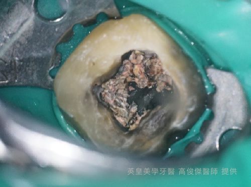 A close up of a tooth with a hole in it.