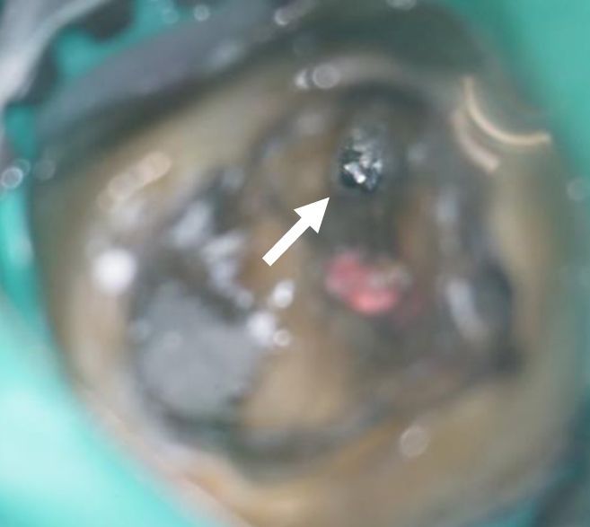 A close up of a tooth with an arrow pointing to it.