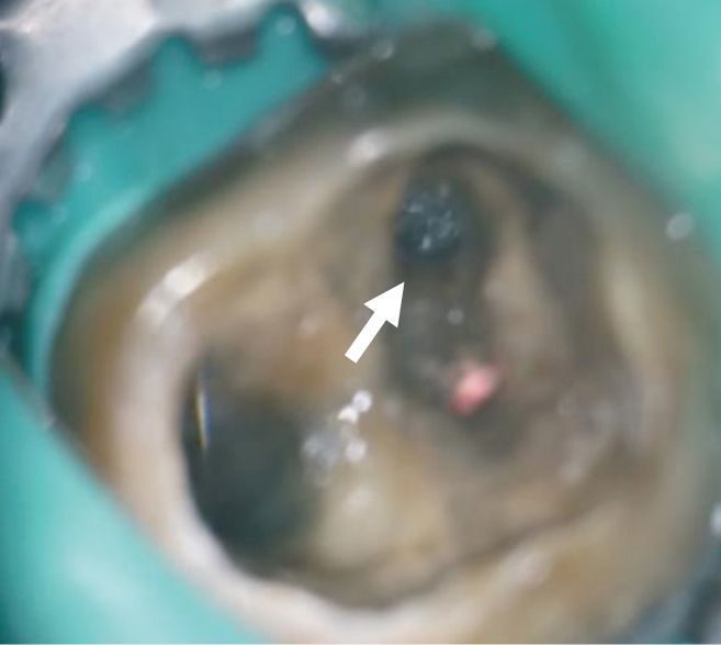 A close up of a hole in a tooth with an arrow pointing to it.