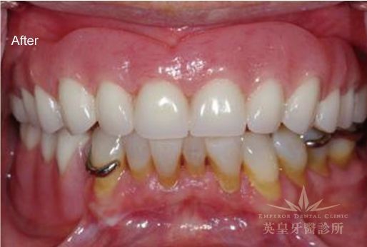 A close up of a person 's teeth with the words after on the bottom