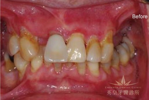A close up of a person 's teeth before a dental treatment