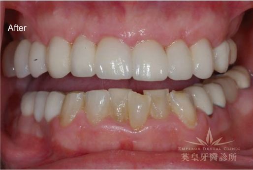 A close up of a person 's teeth with the words after on the bottom