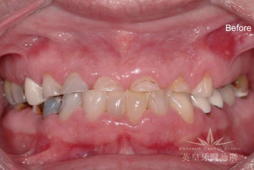 A close up of a person 's teeth before dental work