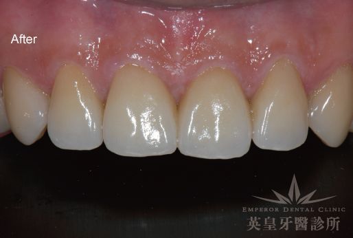 A close up of a person 's teeth with the words after on the bottom