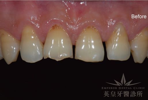 A close up of a person 's teeth with the words emperor dental clinic on the bottom