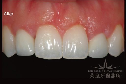A close up of a person 's teeth with the words after on the bottom