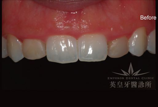 A close up of a person 's teeth with the word before on the bottom