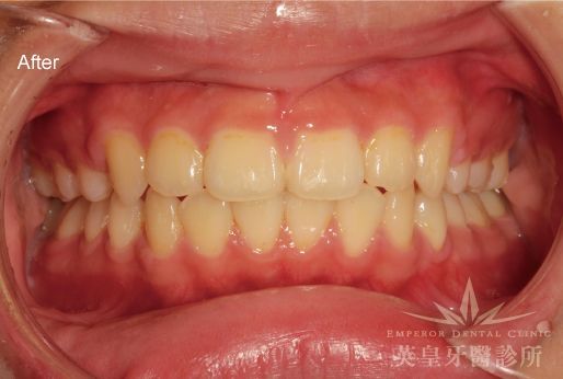 A close up of a person 's teeth before dental treatment