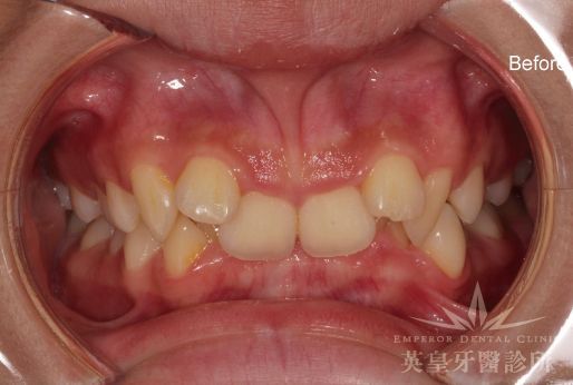 A close up of a person 's mouth with the word before on the bottom