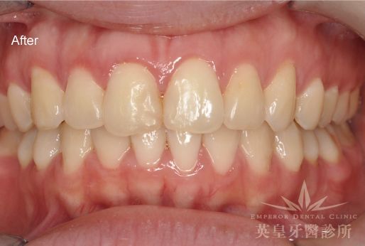 A close up of a person 's teeth with the words after on the bottom