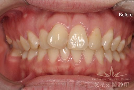 A close up of a person 's teeth before dental treatment