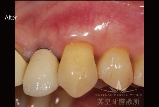 A close up of a person 's teeth with emperor dental clinic written on the bottom