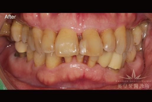 A close up of a person 's teeth with the words after on the bottom