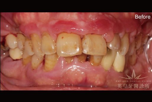 A close up of a person 's teeth with the word before on the bottom