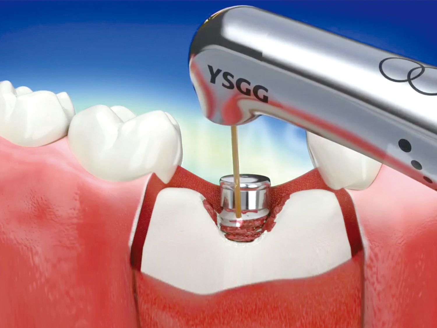 A ysgg device is being used on a tooth