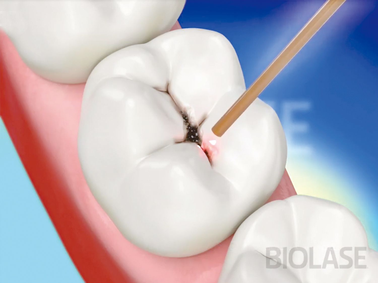 A close up of a tooth with the word biolase on the bottom