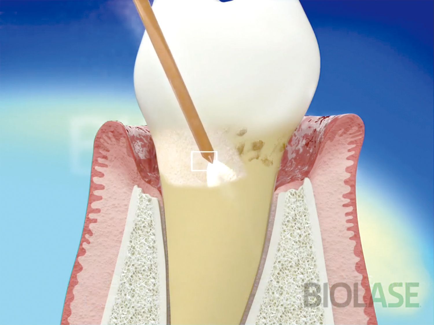 A picture of a tooth with the word biolase on the bottom
