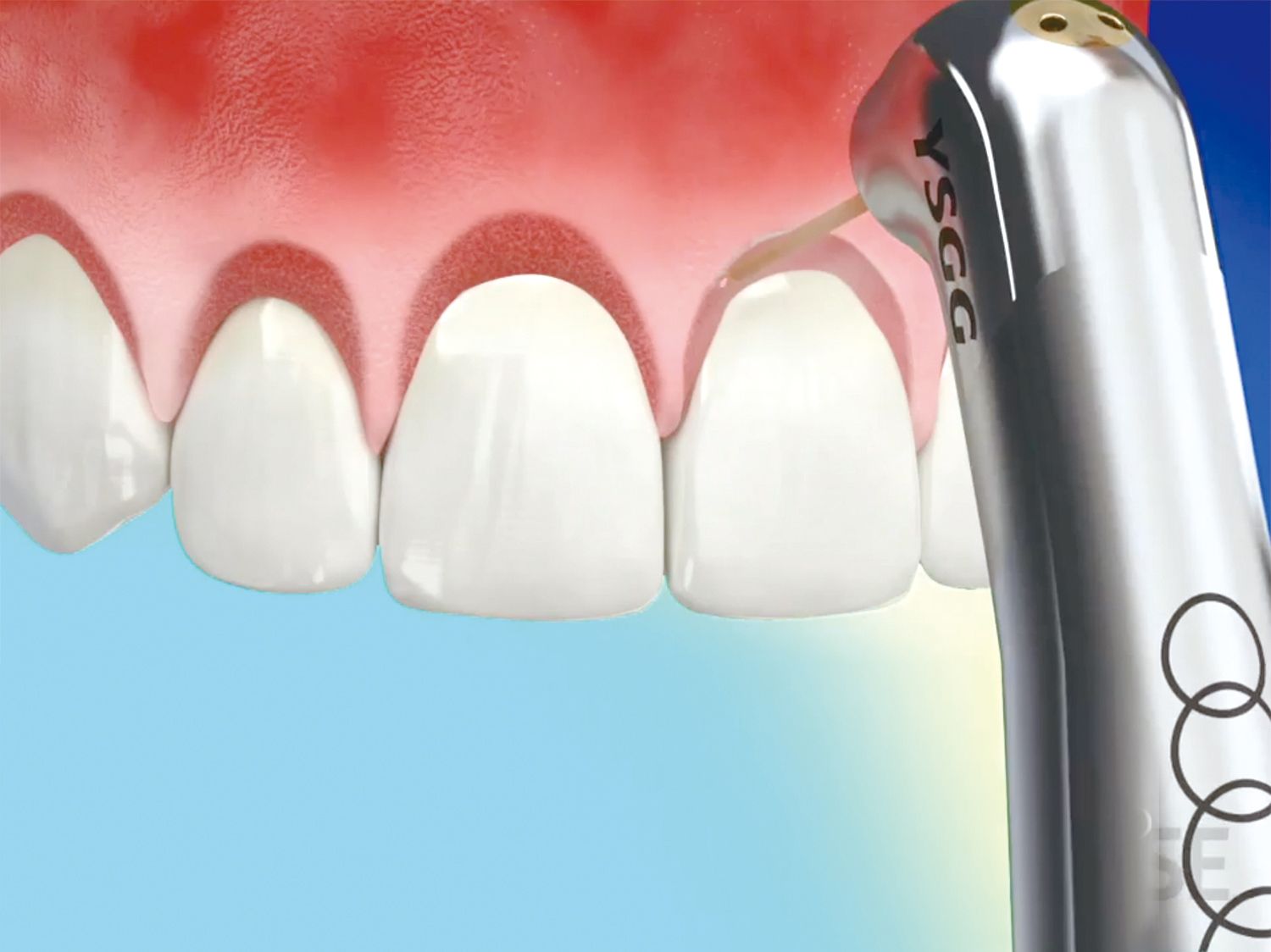 A close up of a person 's teeth with a ysgc device in the background