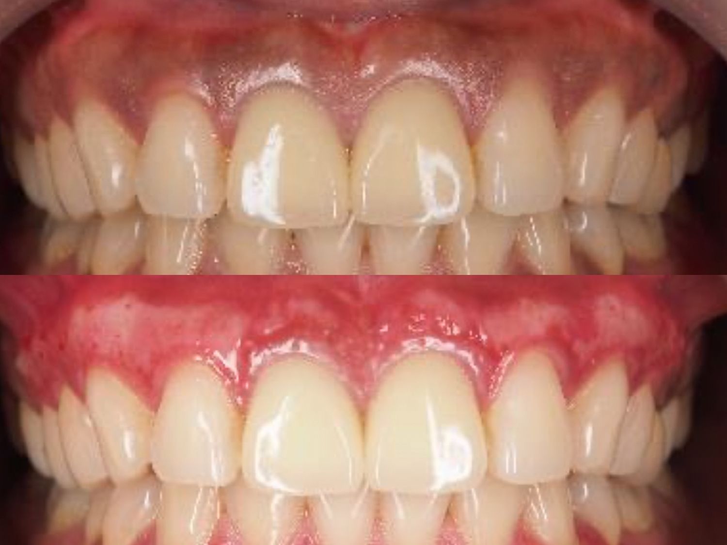A close up of a person 's teeth before and after whitening.