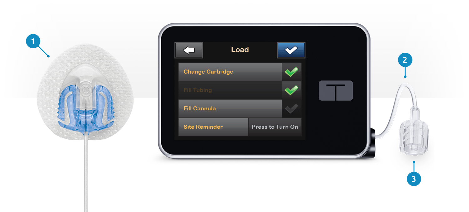 Tandem Insulin Pump Advanced Insulin Delivery for Better Diabetes Control
