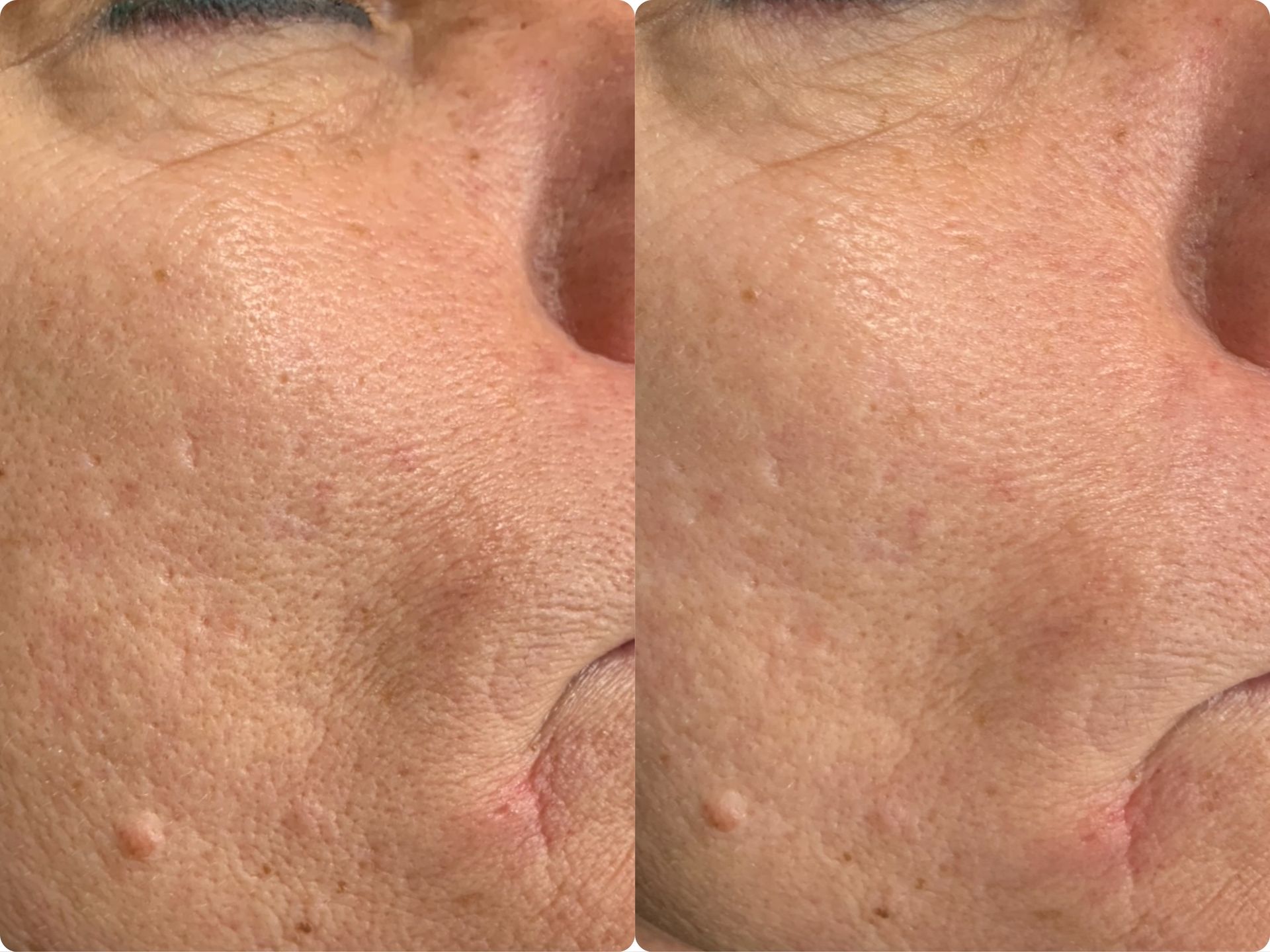 Close-up of a cheek with several small red blemishes and fine skin texture