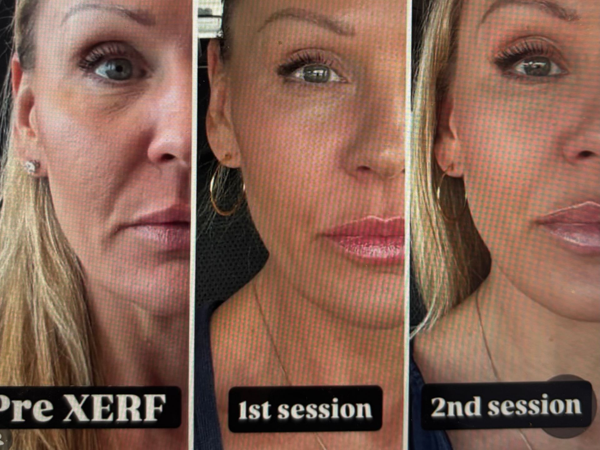 Three-panel facial comparison labeled “Pre XERF,” “1st session,” and “2nd session” showing skin changes