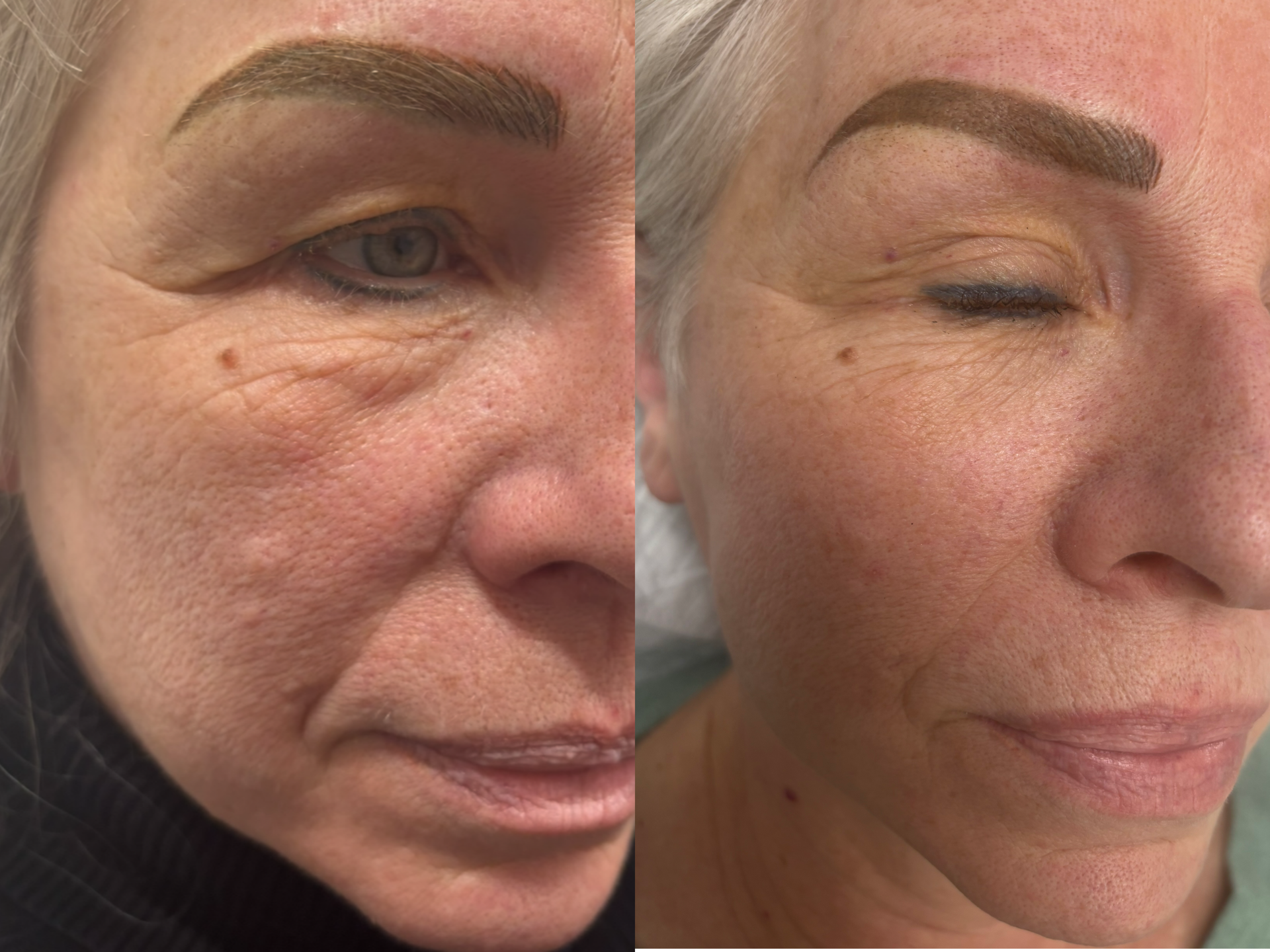Profile view of an older woman showing a side-by-side before-and-after neck profile comparison