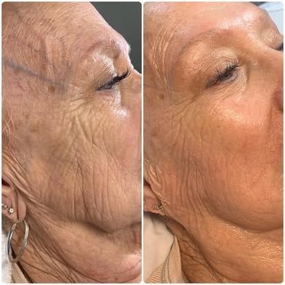 Side-by-side close-up of a face, showing before-and-after skin smoothing with fewer wrinkles