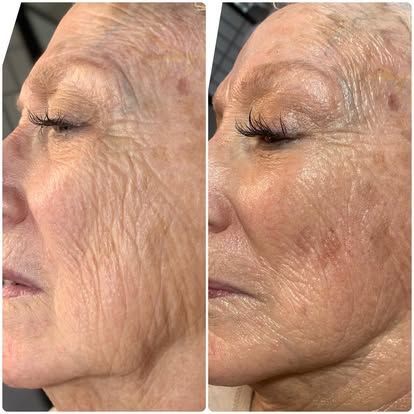 Side-by-side close-up profile of a woman’s face showing before and after skin treatment.