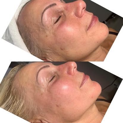 Side-by-side close-up facial profile before and after a cosmetic treatment, showing smoother skin and glow