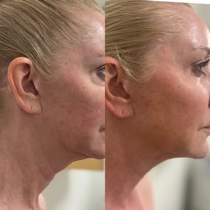 Profile view of an older woman showing a side-by-side before-and-after neck profile comparison