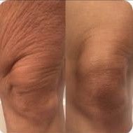 Side-by-side close-up of wrinkled skin, showing a darker patch on the left and a smoother area on the right