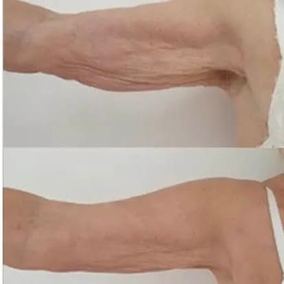 Two side-view forearm photos showing wrinkled, sagging skin before and after flattening.