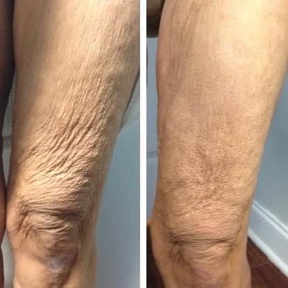 Side-by-side close-up of a knee with wrinkled skin before and after smoothing.