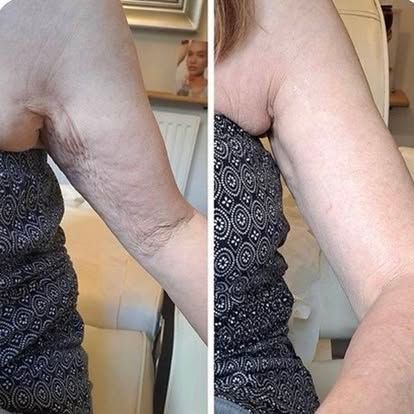 Side-by-side close-up of an arm before and after a visible reduction in loose, wrinkled skin