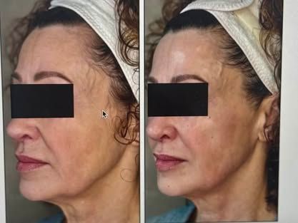 Side-by-side profile photos of a woman, showing facial contours before and after treatment.