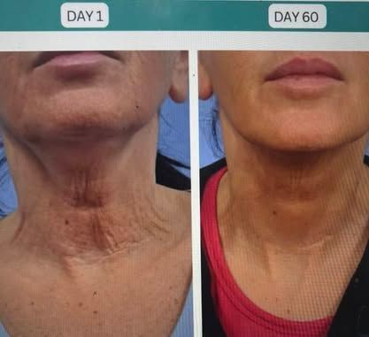 Side-by-side neck photos labeled Day 1 and Day 60, showing reduced dark skin discoloration.