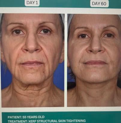 Before-and-after face photos labeled Day 1 and Day 60, showing smoother skin and reduced wrinkles.