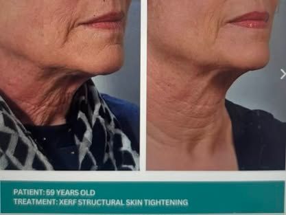 Before-and-after profile photos of neck skin tightening treatment, showing smoother neck skin on the right.