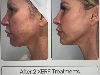 Side-by-side facial profile photos showing skin improvement after two XERF treatments.