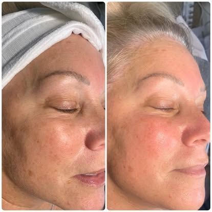 Side-by-side close-up of a person’s face before and after facial treatment, with redder skin after treatment