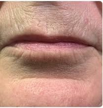 Close-up of a closed mouth with a dark bruise or discoloration under the lower lip